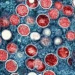 Monkeypox di Amerika Serikat dan di Seluruh Dunia: Situasi Saat Ini