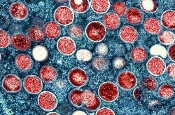 Monkeypox di Amerika Serikat dan di Seluruh Dunia: Situasi Saat Ini